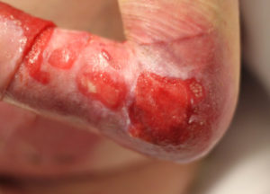 rdeb wound